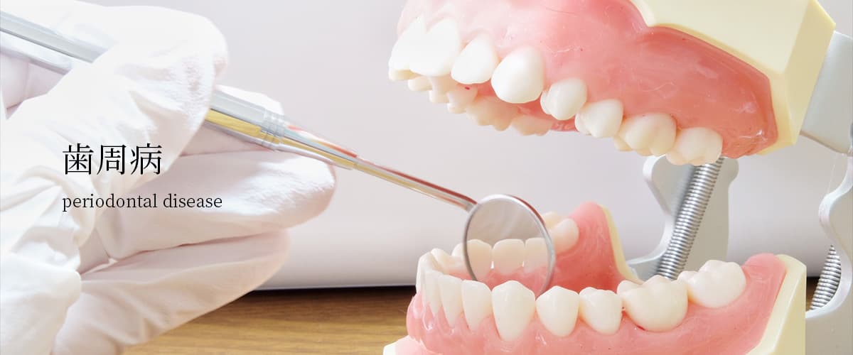 歯周病治療のイメージ