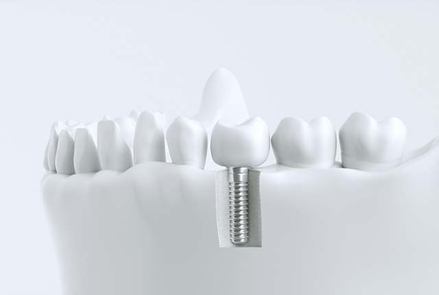 インプラントの模型