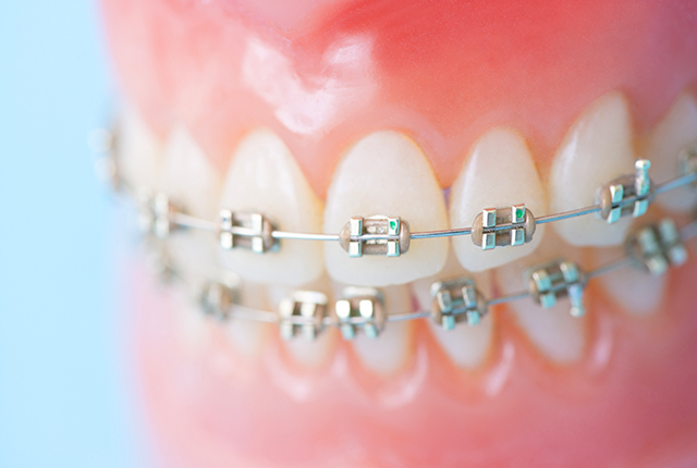 歯科矯正器具
