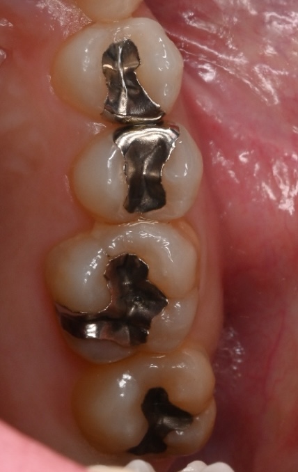 安城市 歯科 ダイレクトボンディング 治療前 銀歯の状態