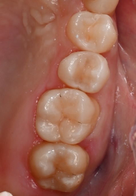 安城市 歯科 ダイレクトボンディング 治療後 銀歯を白く修復した症例